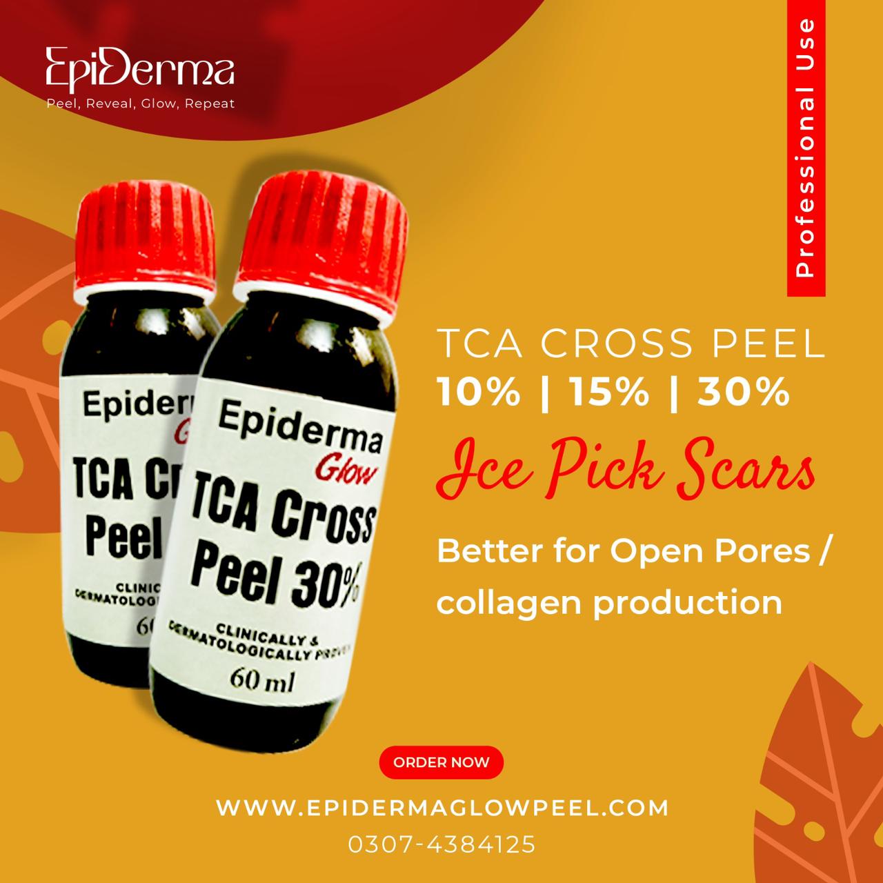 "TCA Cross Peel 30% treatment for acne scars and skin texture improvement"
